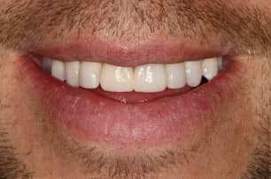 dental veneers after