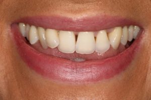 Invisalign Braces Norwich | Invisible & Clear Aligners Norwich at ...