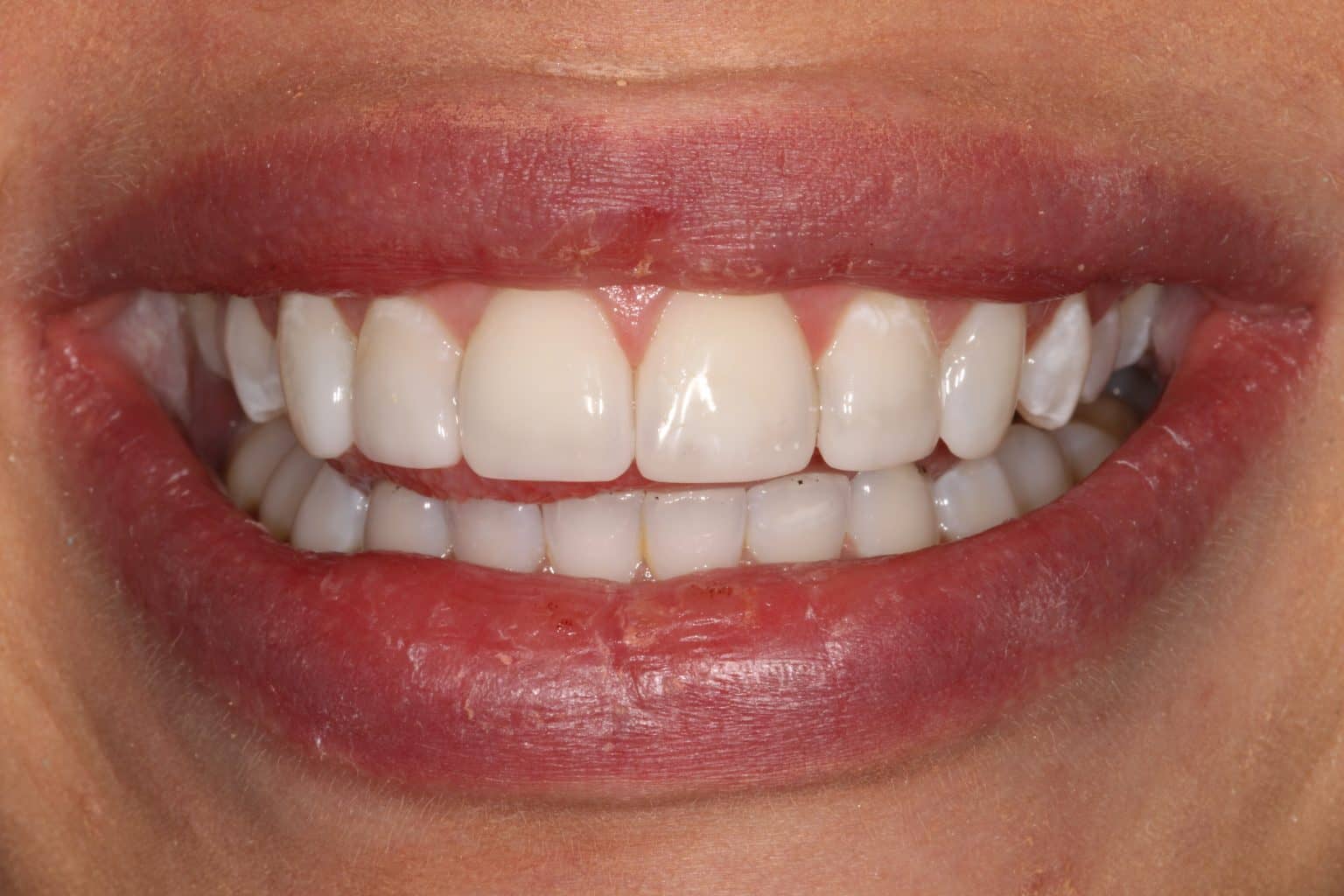 Composite Bonding Norwich Cosmetic Bonding At Newmarket Road Dental
